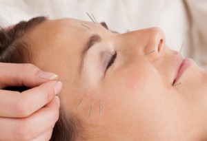 Woman receiving facial acupuncture treatment
